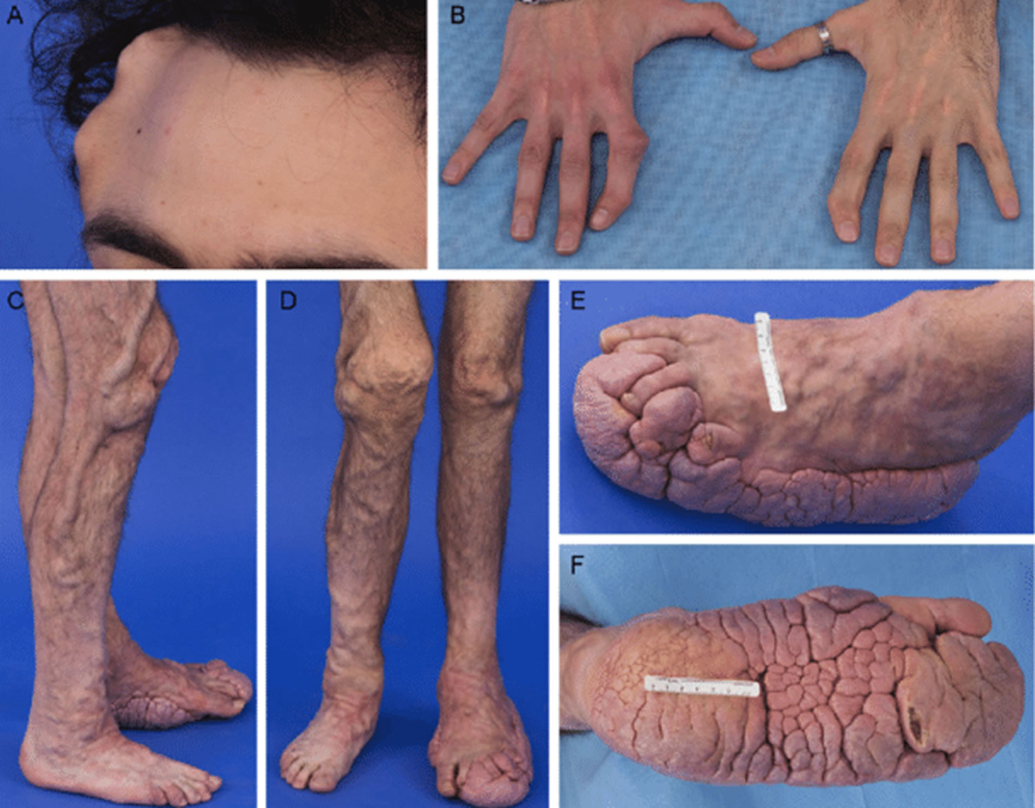 proteus syndrome photos