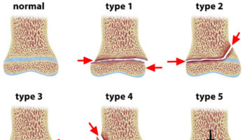 Salter Harris fracture