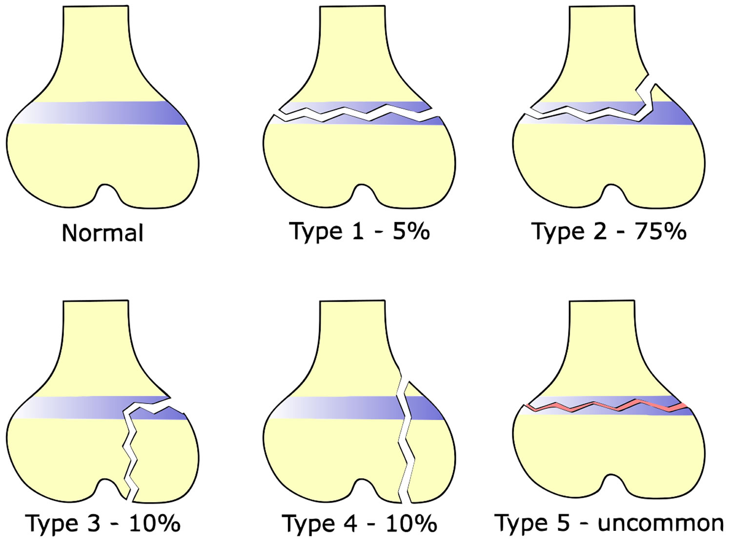 Salter Harris fracture types