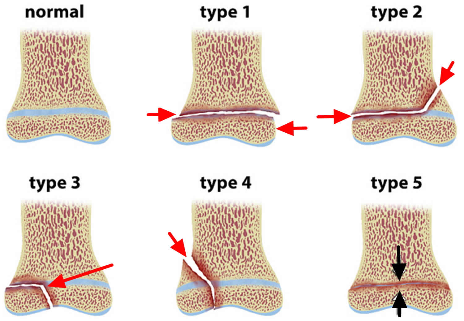 Salter Harris Fracture Definition Types Symptoms Diagnosis And Treatment