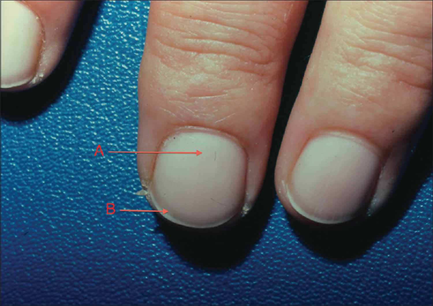 Lunula definition, lunula function & nail problems