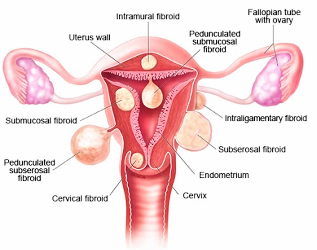 Myomectomy Procedure Risks Recovery Time And Pregnancy After Myomectomy