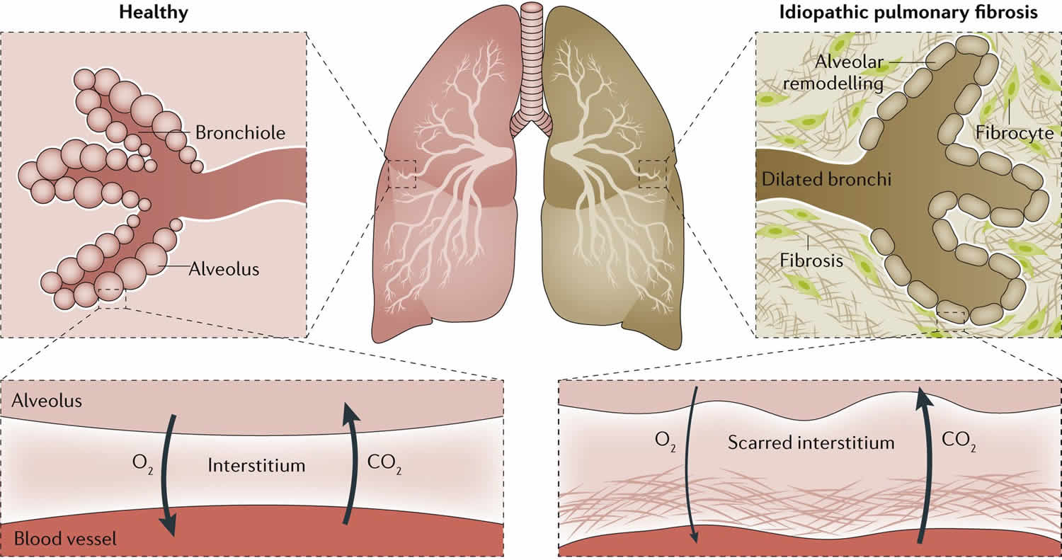 pulmonary-fibrosis-causes-types-symptoms-diagnosis-stages-treatment