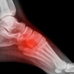lisfranc injury