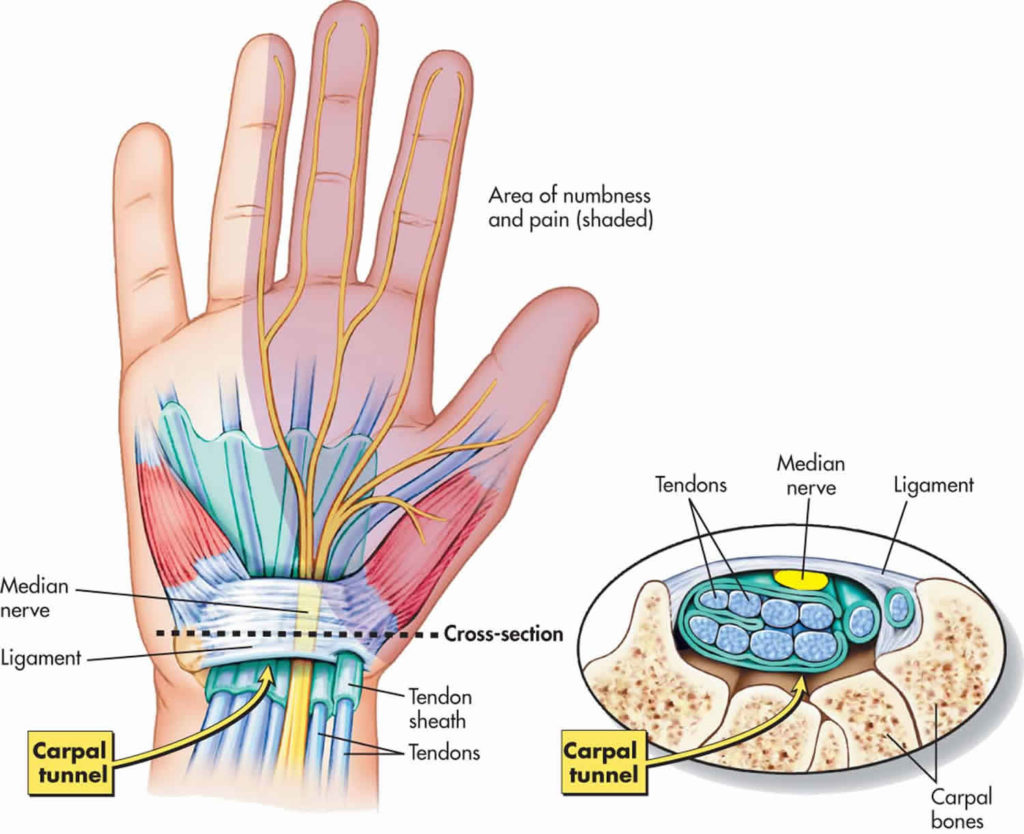 Nerve Compression Causes Symptoms Diagnosis Treatment   Median Nerve Compression 1024x834 