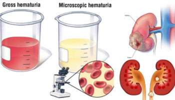 microhematuria