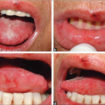 mucositis