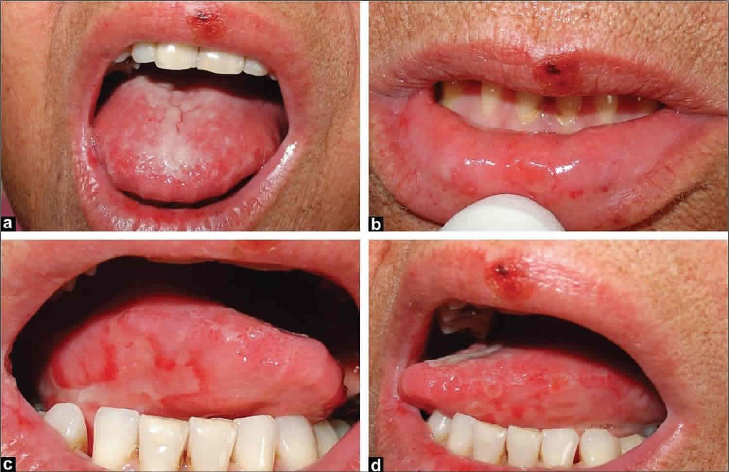 Oral Mucositis Definition, Causes, Symptoms, Treatment -2710