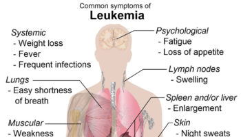 myelogenous leukemia