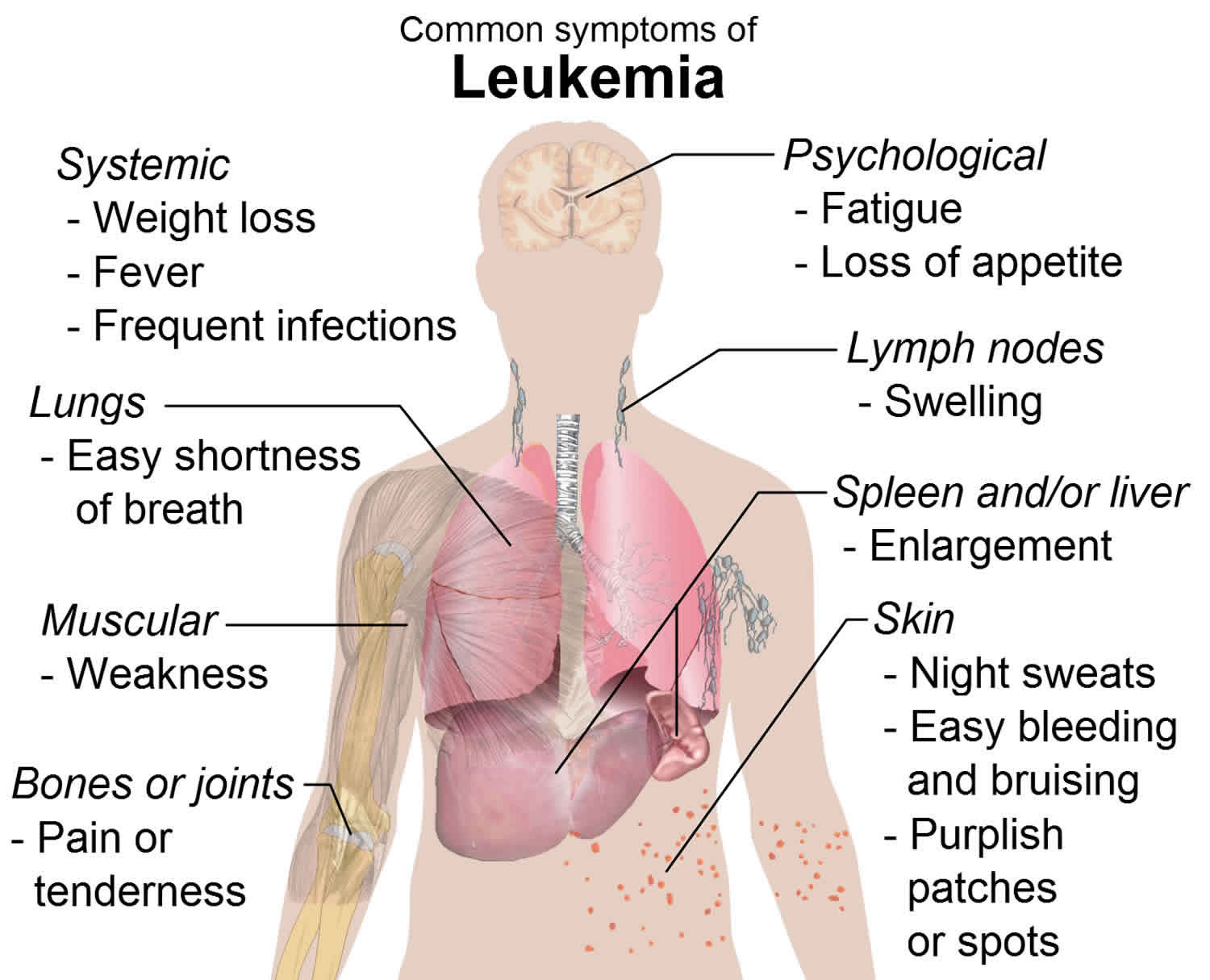 Сыпь лимфоузлы температура. Основные симптомы лейкемии.