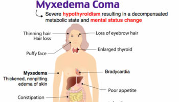 myxedema coma