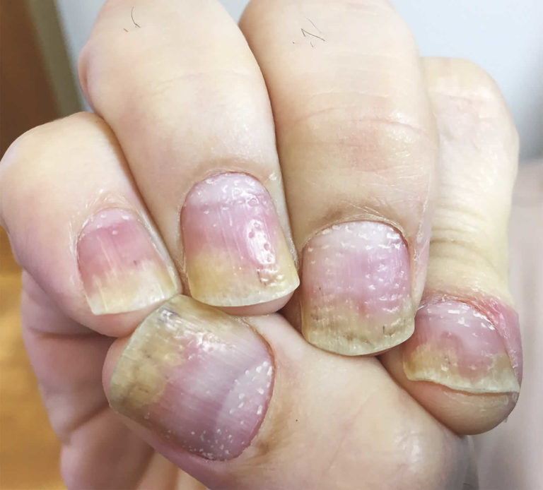 Lunula definition, lunula function & nail problems