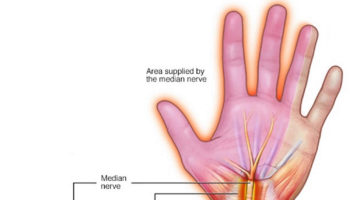 nerve compression