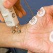 nerve conduction study