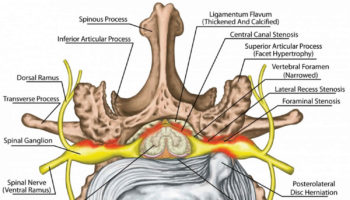 neural foraminal stenosis