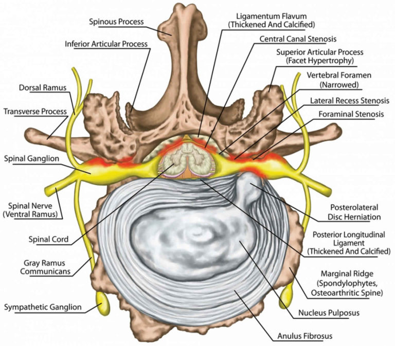 spinal-stenosis-definition-causes-symptoms-diagnosis-and-treatment