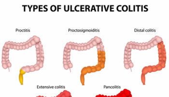 pancolitis