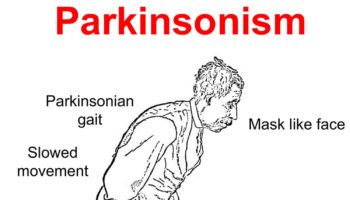 parkinsonism