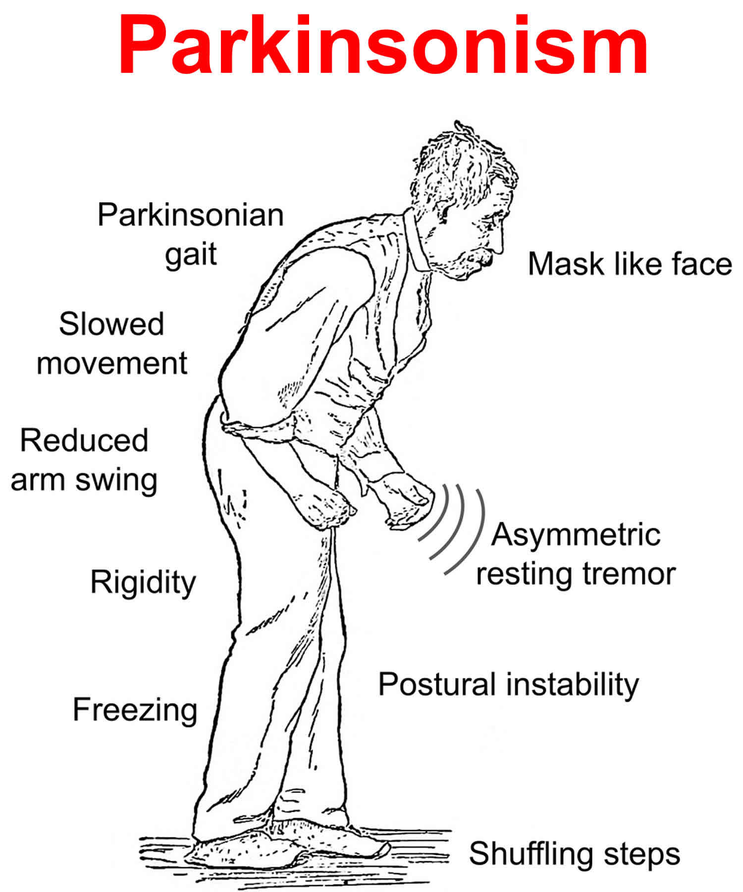 Parkinsonism Vs Parkinsons Disease