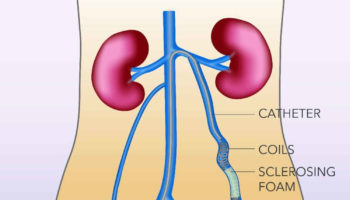 pelvic congestion syndrome