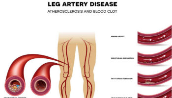 peripheral vascular disease