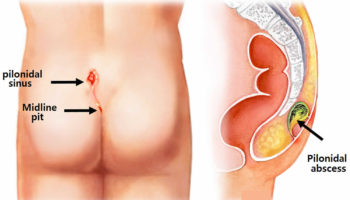 pilonidal sinus