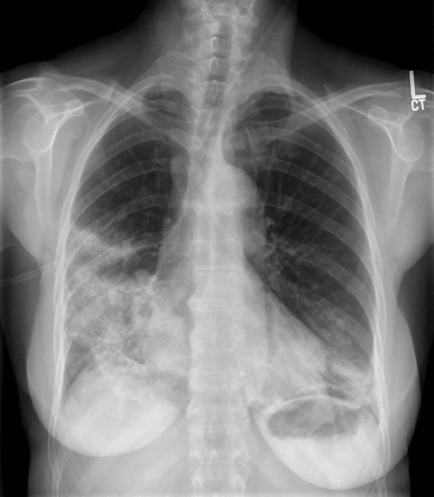 List 91+ Images pictures of popcorn lung disease Superb