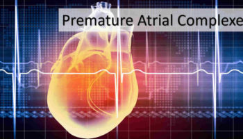 premature atrial contraction