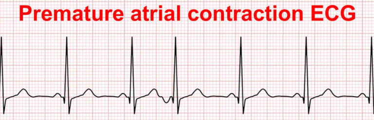 premature-atrial-complex-pac-ecg-recognition-grepmed-gambaran