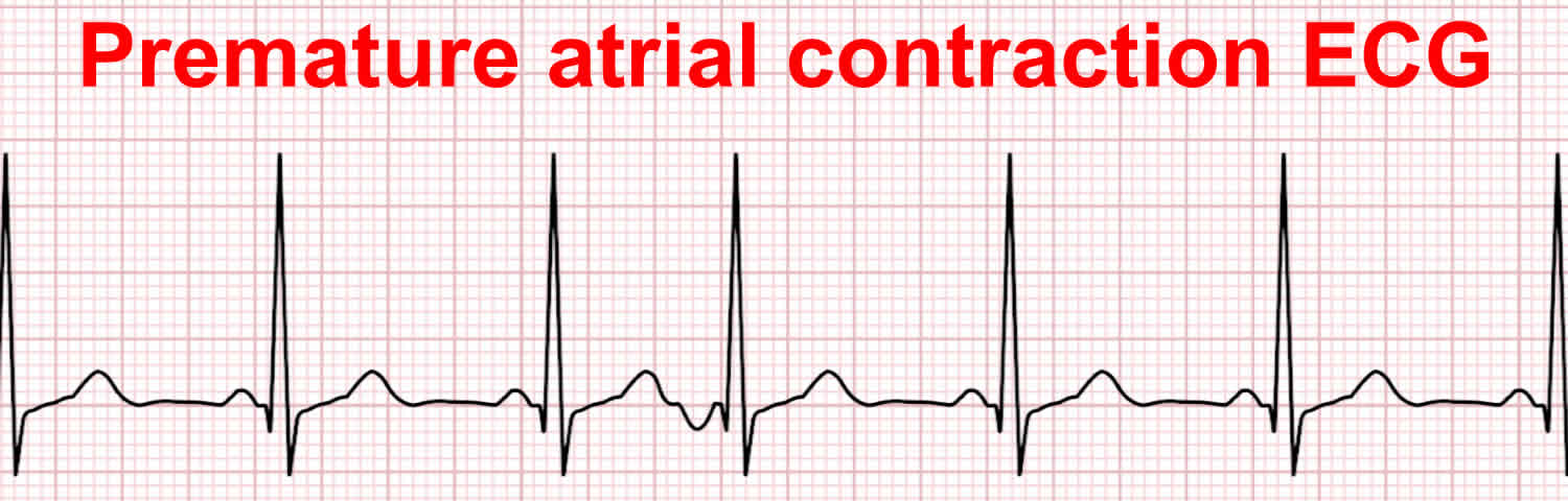 Premature Atrial Contraction Strip