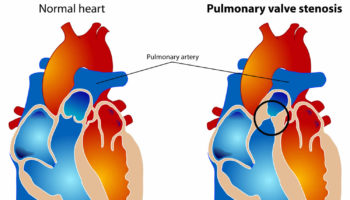 pulmonary stenosis