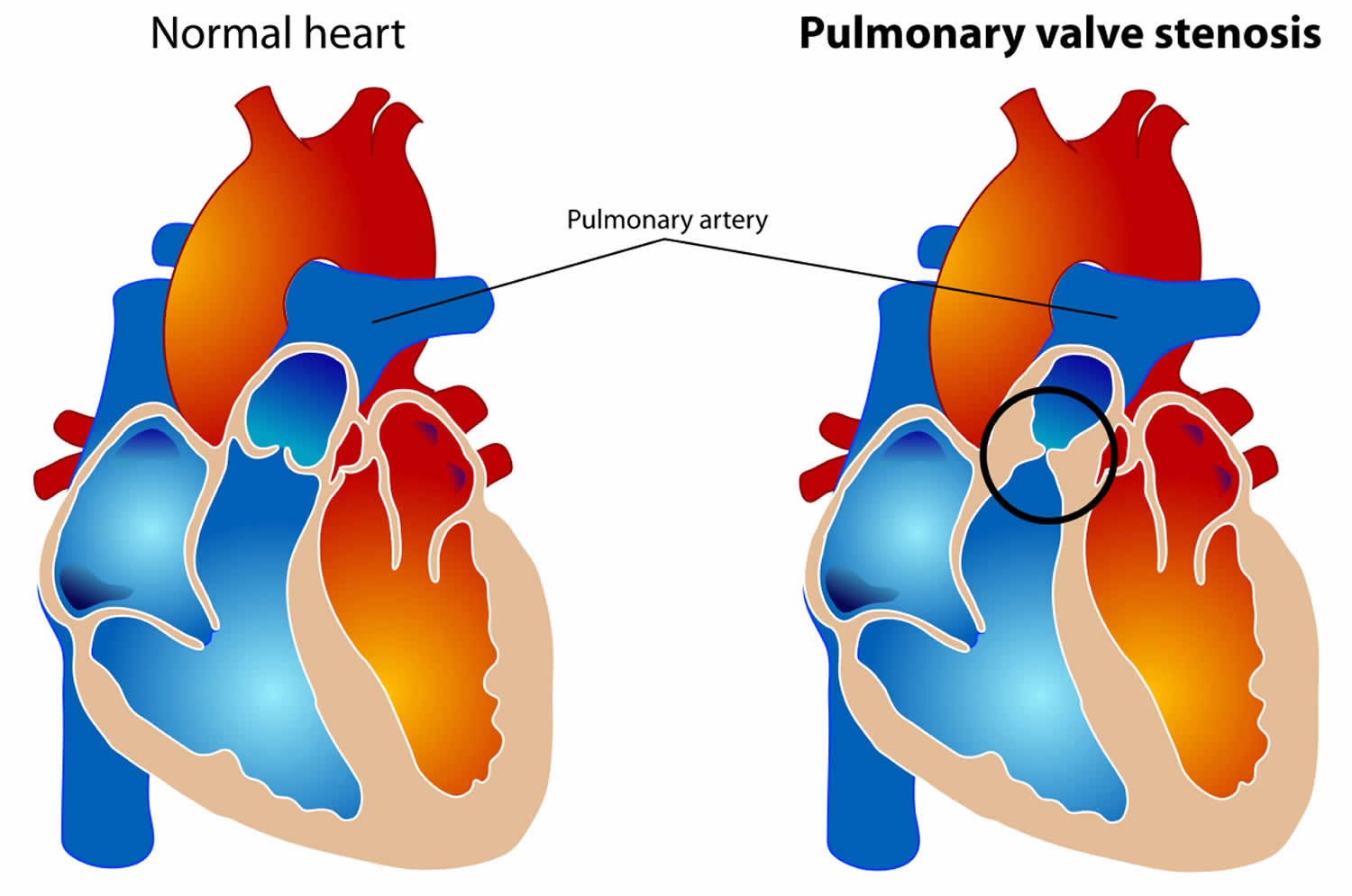 pulmonary-atresia-causes-types-symptoms-diagnosis-treatment