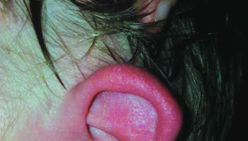 red ear syndrome