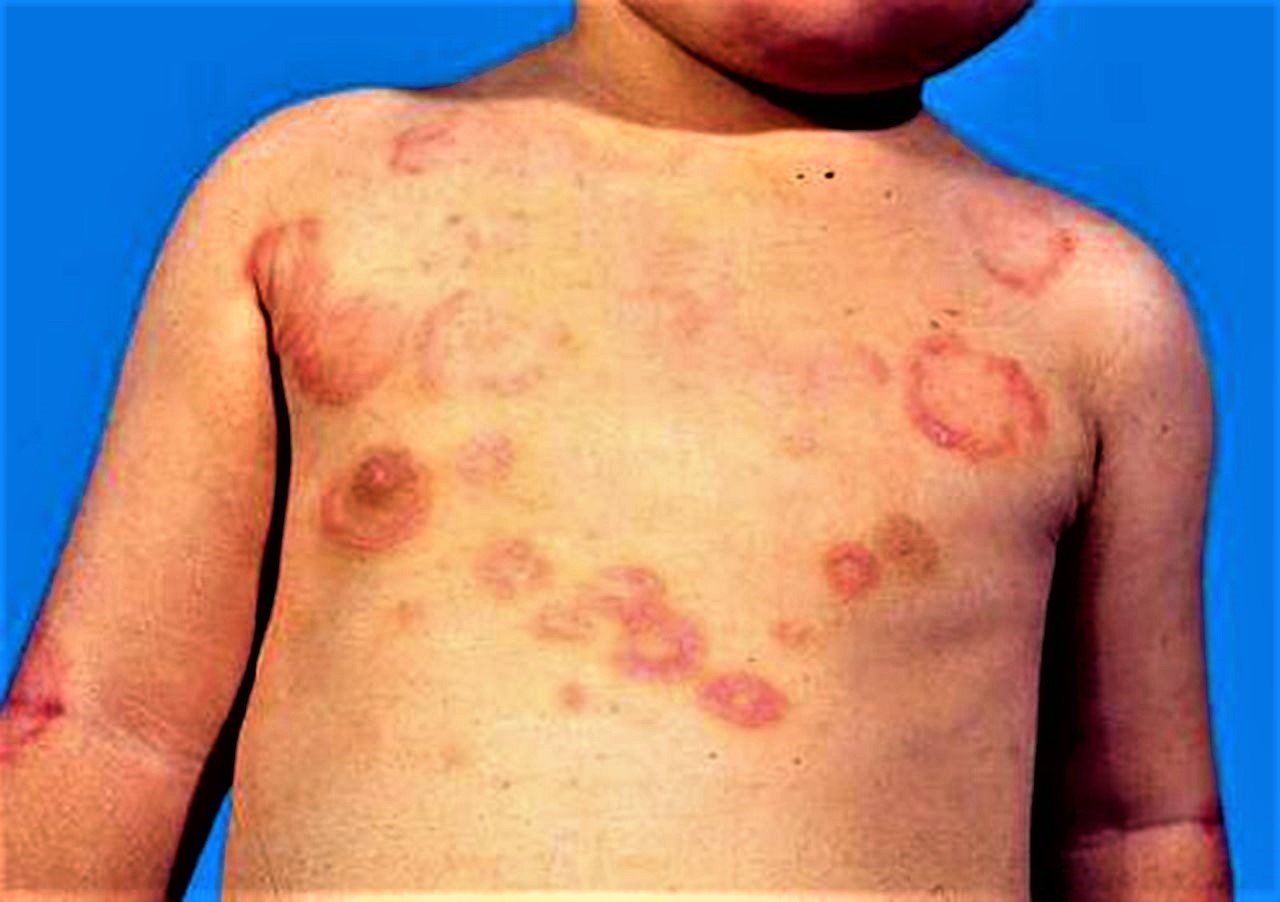 scarlet-fever-causes-symptoms-treatment-and-complications