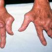 rheumatoid nodules