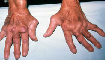 rheumatoid nodules