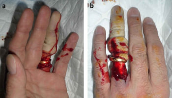 ring avulsion injury