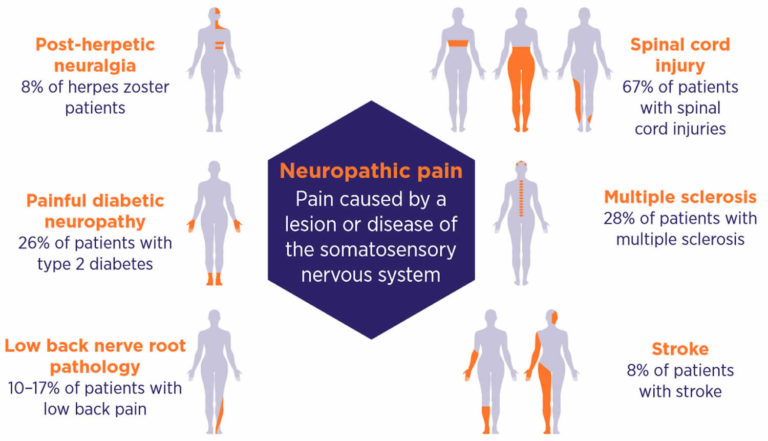 Neuropathic pain definition, types, causes, symptoms, diagnosis & treatment