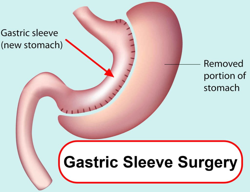 Gastric sleeve surgery, indications, risks & complications