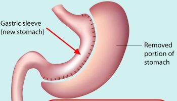 Gastric sleeve