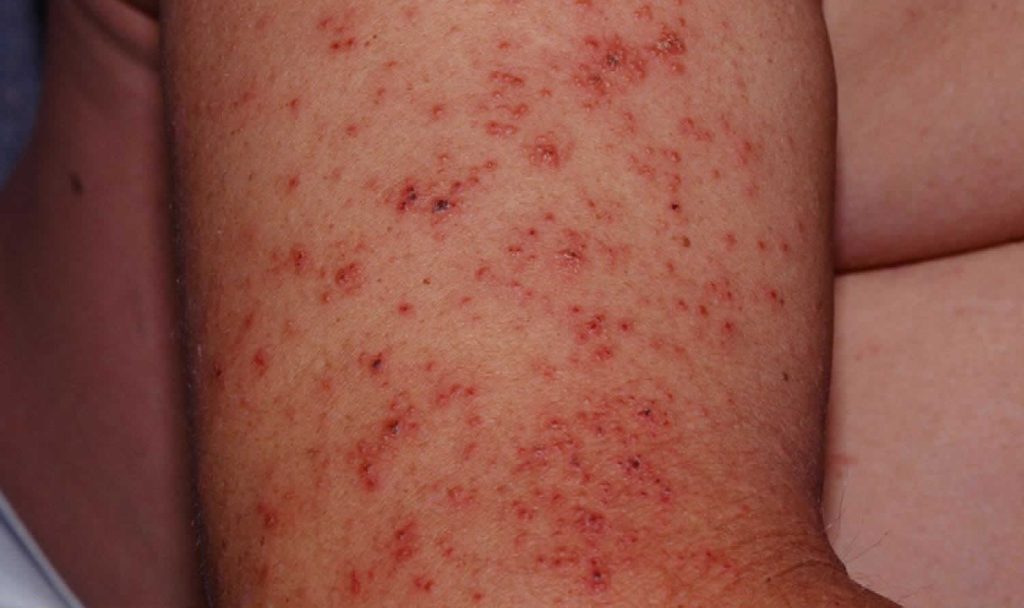 Tinea Barbae Definition Causes Symptoms Diagnosis And Treatment 1235