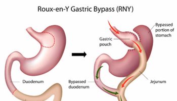 Roux-en-Y gastric bypass