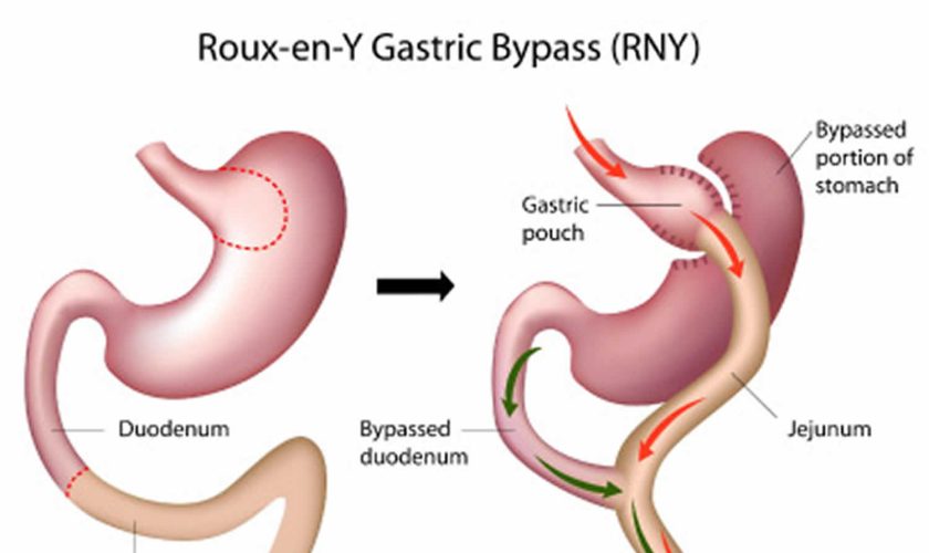 Roux-en-Y gastric bypass