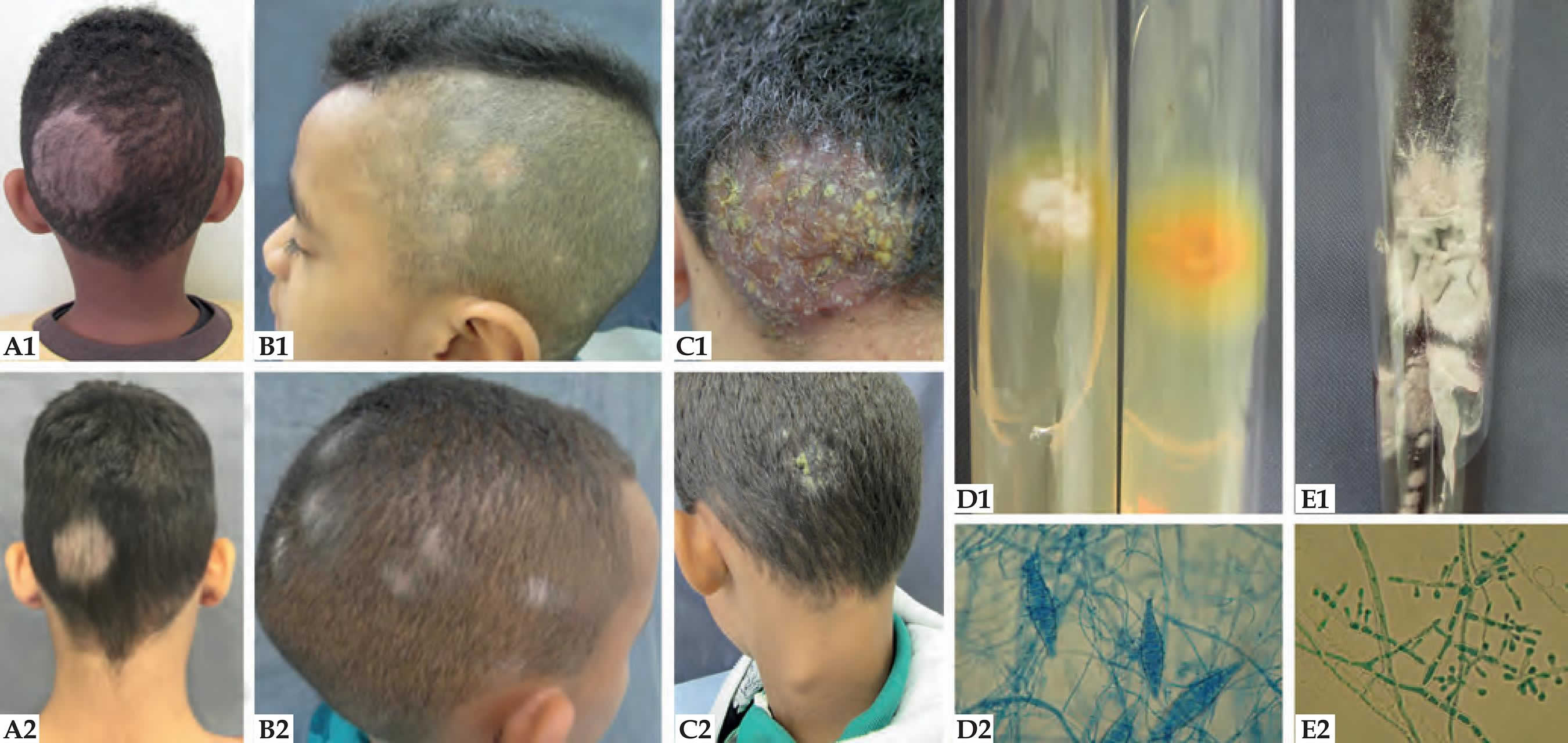 Tinea capitis scalp, causes, symptoms, diagnosis & tinea capitis treatment