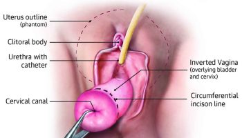 Vaginal-hysterectomy