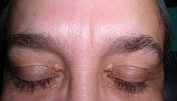 Xanthelasma