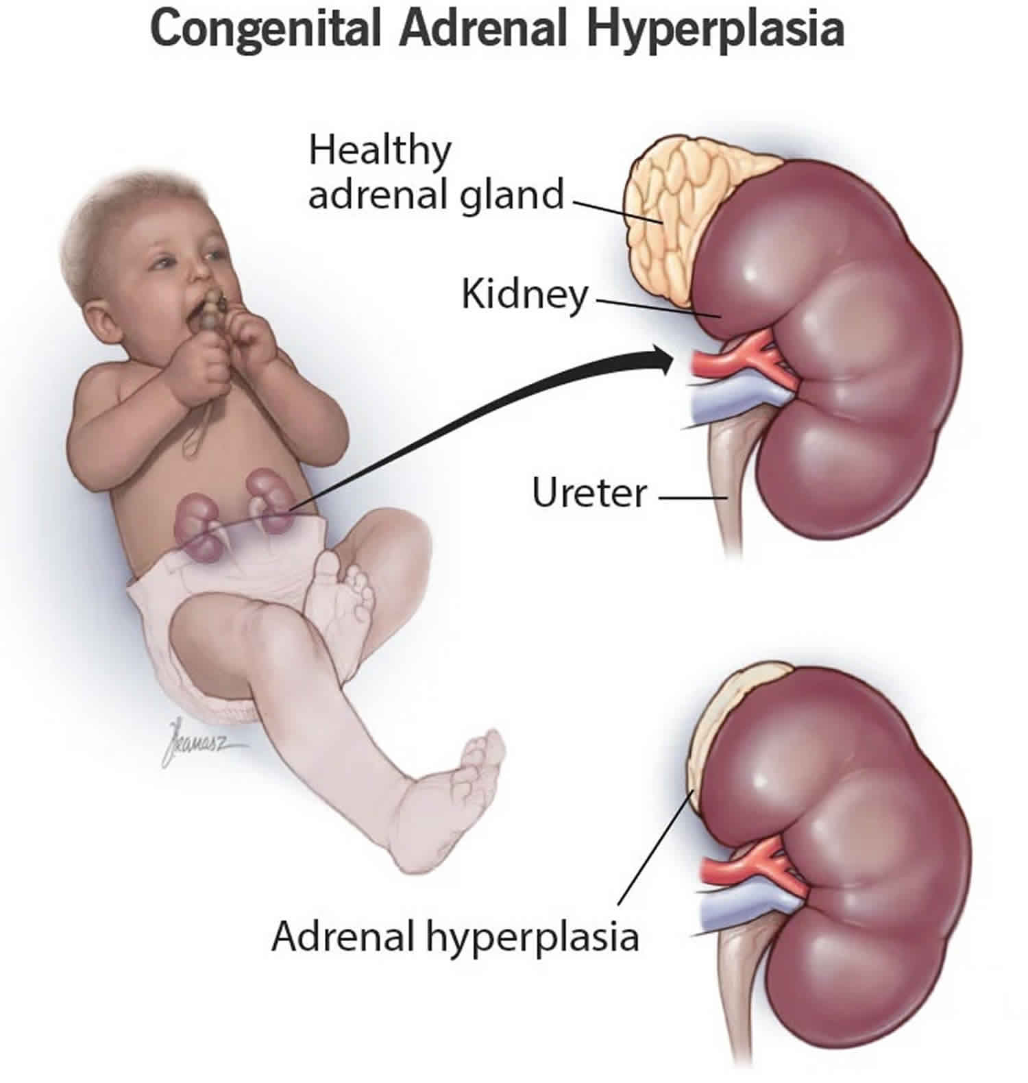 adrenal-hyperplasia