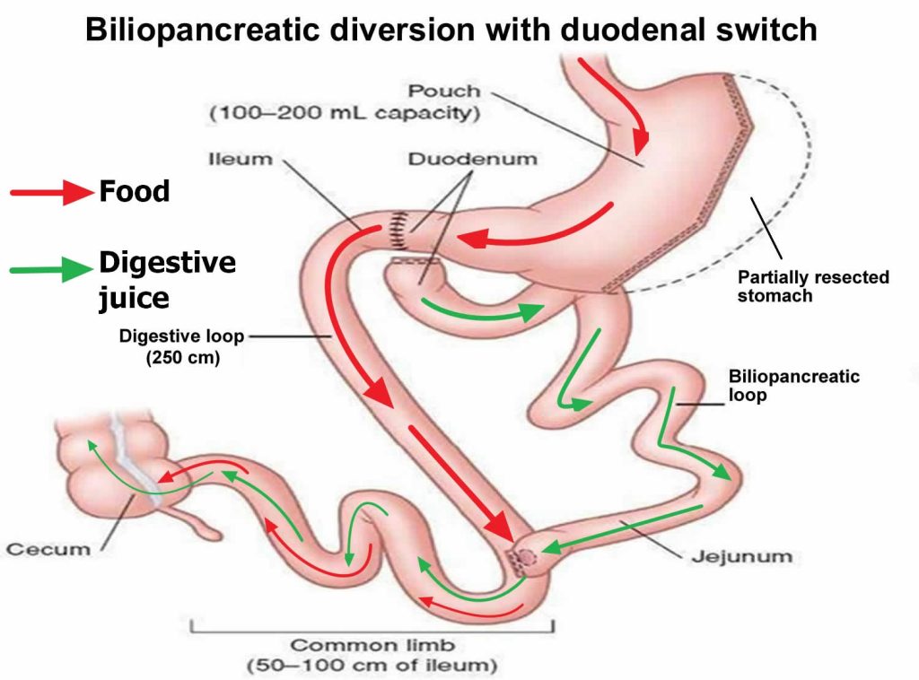 Biliopancreatic diversion with duodenal switch, side effects