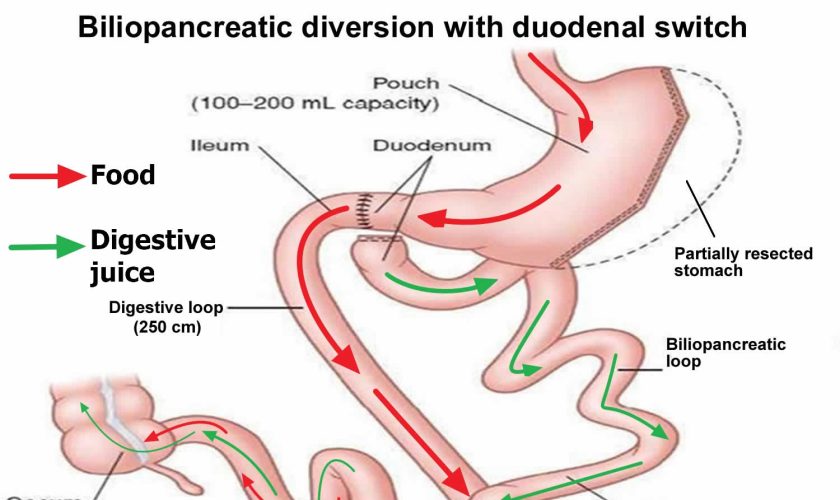 biliopancreatic diversion with duodenal switch