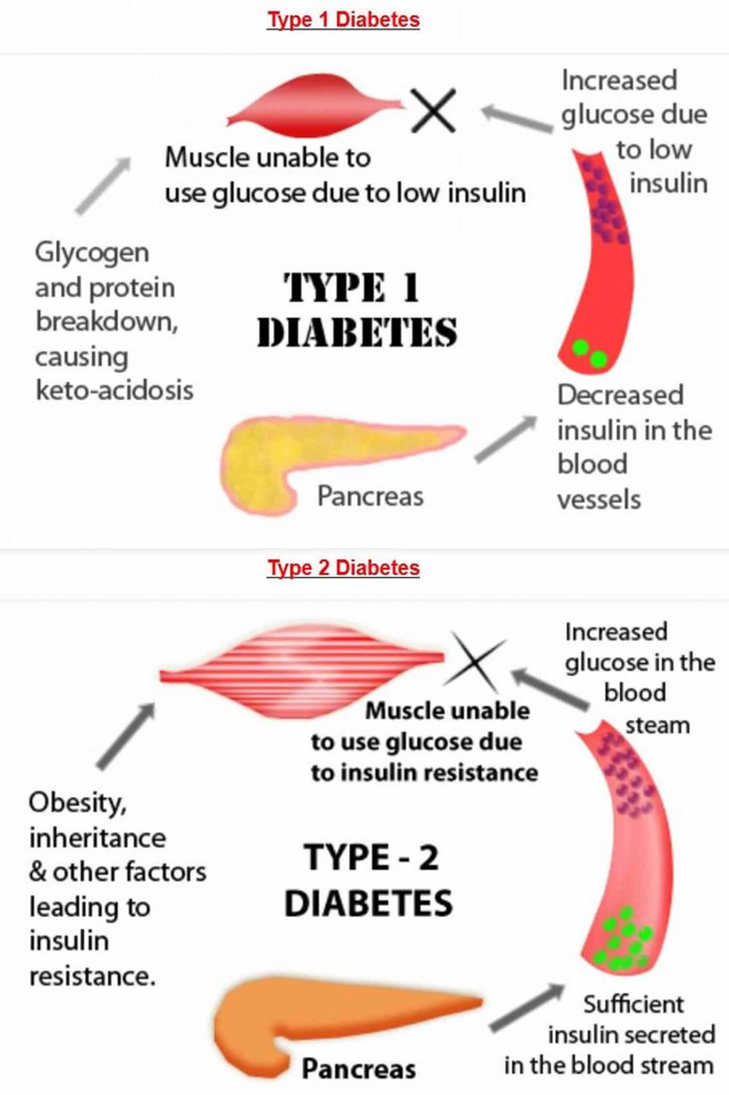 Differences between type 1 and type 2 diabetes